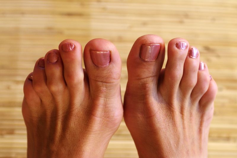 Hammertoes!  How to treat based on type